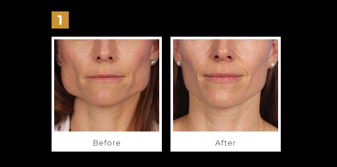 Jawline Slimming And Treatment Of Bruxism Instant Laser Clinic