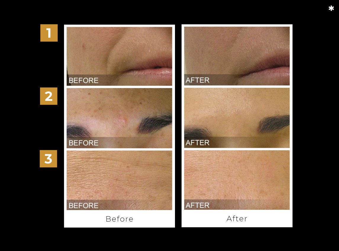 Fotona Nd Yag Laser Instant Laser Clinic